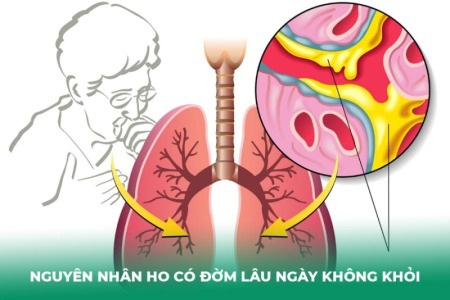 8 Cách Trị Ho Có Đờm Lâu Ngày Không Khỏi Tại Nhà