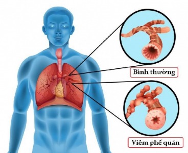 Viêm phế quản – bệnh hô hấp dễ mắc phải ở mọi lứa tuổi