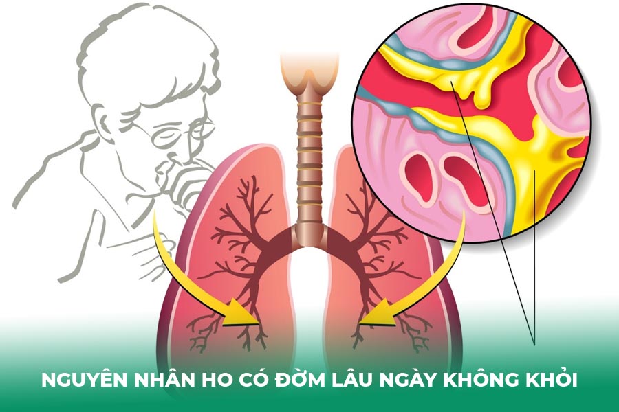 Nguyên nhân ho có đờm lâu ngày không khỏi