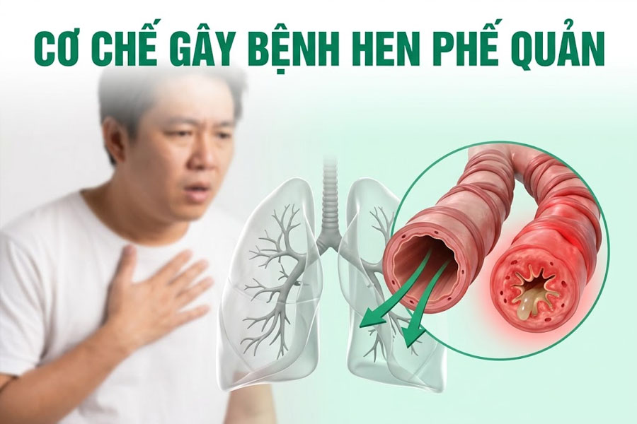 Cơ Chế Gây Bệnh Hen Phế Quản