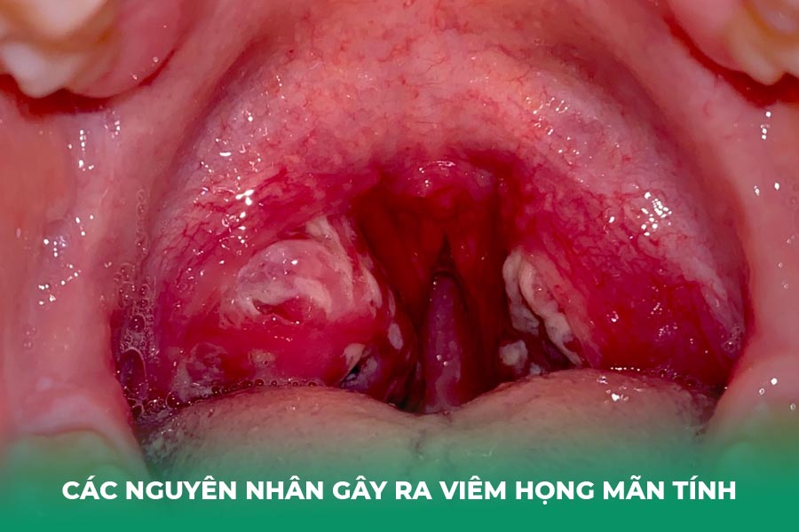 Các Nguyên Nhân Gốc Rễ Gây Ra Viêm Họng Mãn Tính