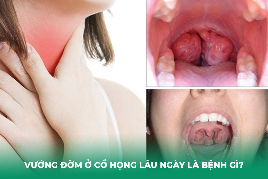 Vướng Đờm Ở Cổ Họng Lâu Ngày Là Bệnh Gì?