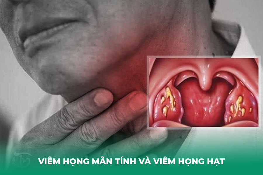 Viêm Họng Mãn Tính và Viêm Họng Hạt